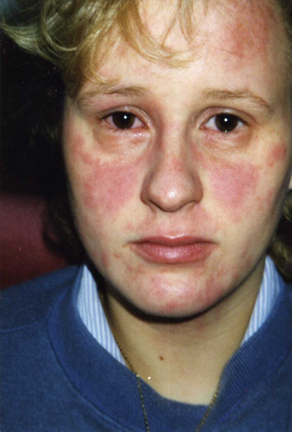 Suzanne John's eczema flared in her 20's